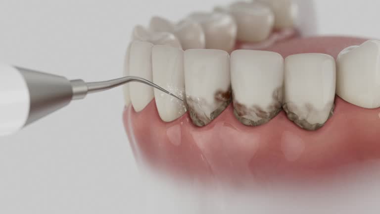 Trusted Dental Crowns And Bridges service in St. Matthews, KY - Dentist Open Now